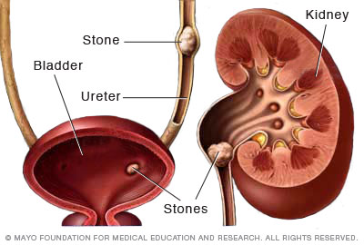 kidney_stonesthu_jpg
